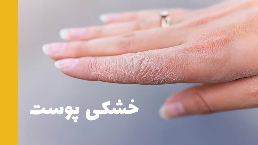 خشکی پوست