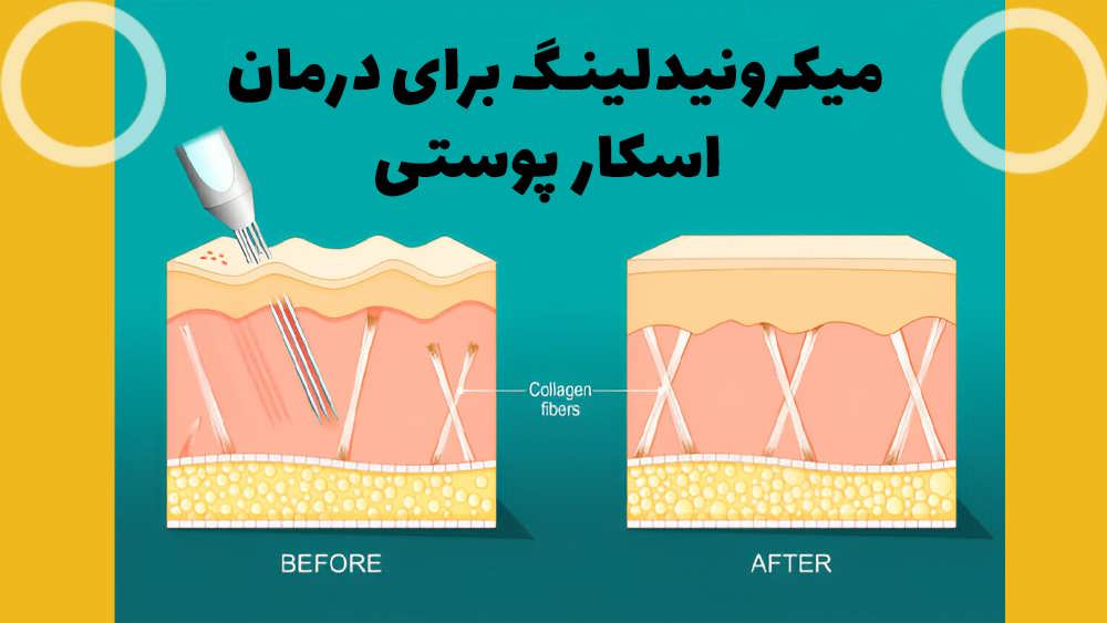 میکرونیدلینگ