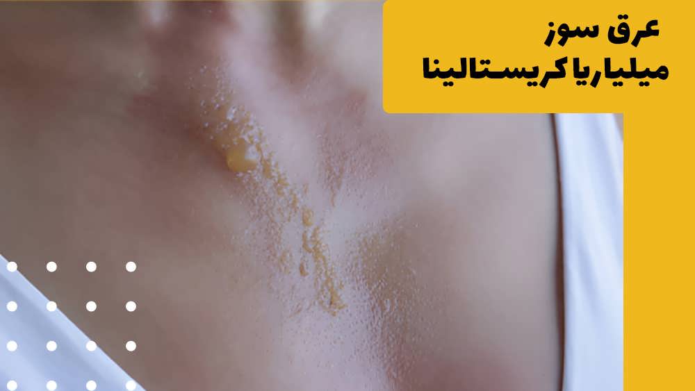 انواع عرق سوز شدن کدامند