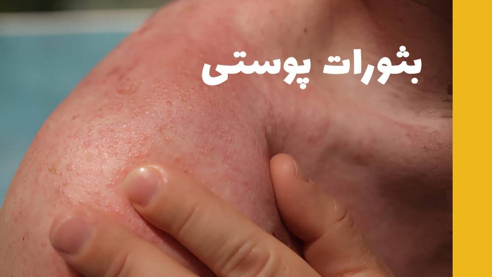 بثورات پوستی