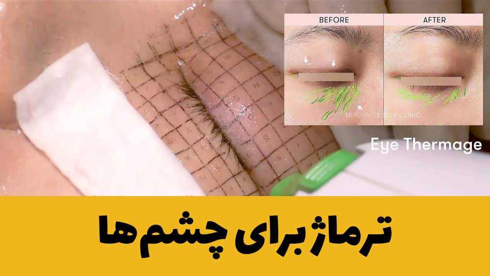 ترماژ برای چشم ها