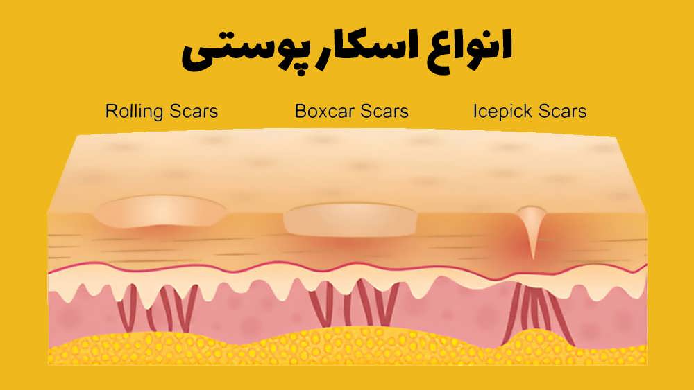 انواع اسکار پوستی