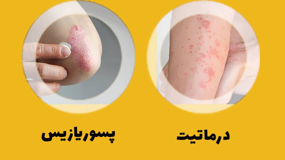 تفاوت بین درماتیت و پسوریازیس چیست؟