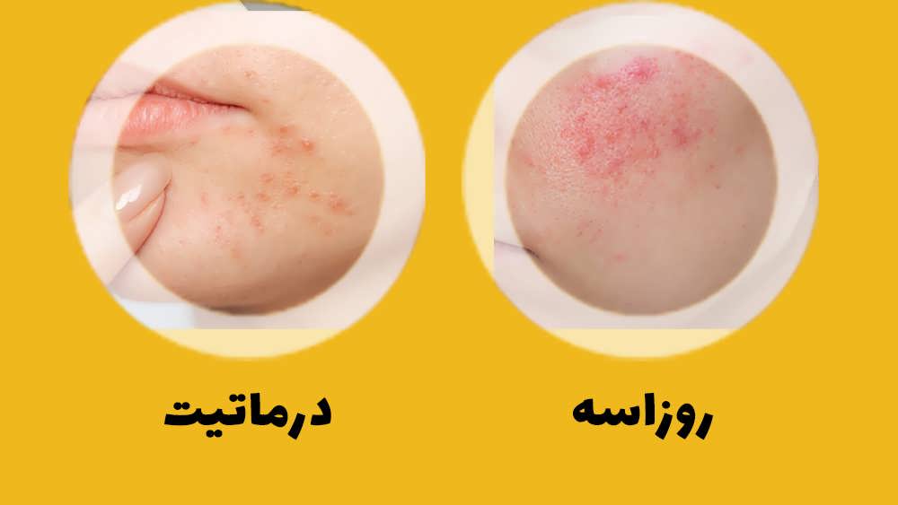 تفاوت بین درماتیت و روزاسه چیست؟