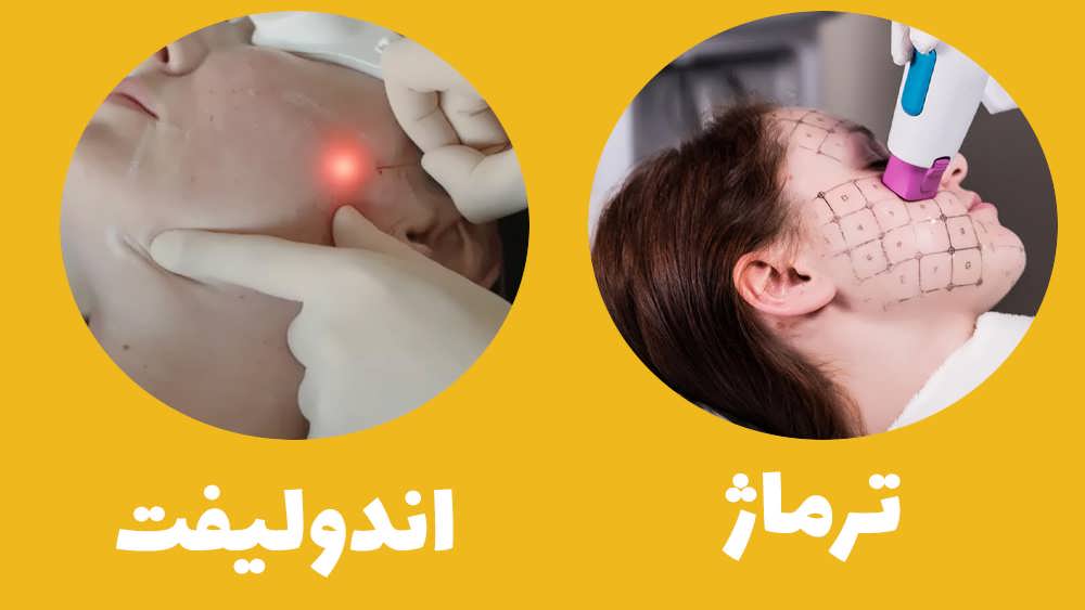 تفاوت ترماژ با اندولیفت در چیست؟