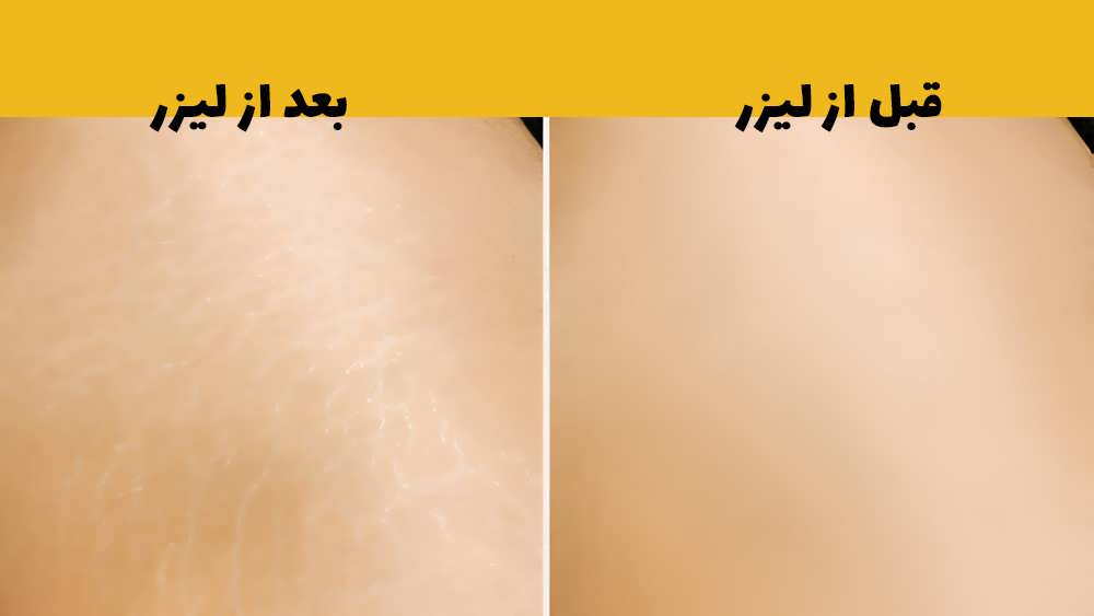 درمان ترک پوستی با لیزر درمانی