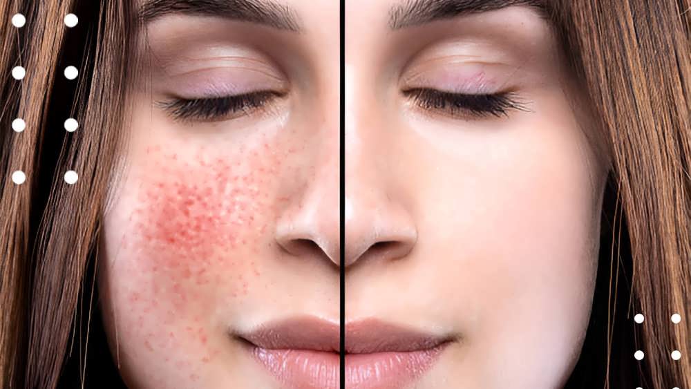 مزایای آزلائیک اسید برای پوست
