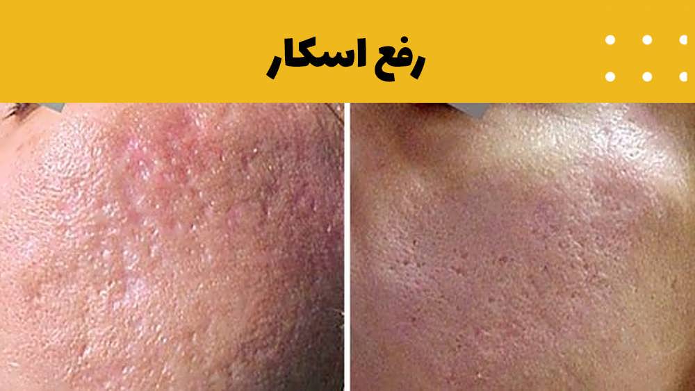 لیزر فوتونا برای اسکار