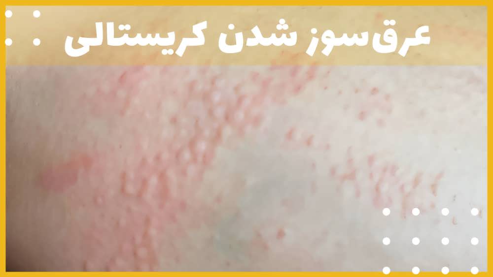 عرق سوز شدن کریستالی