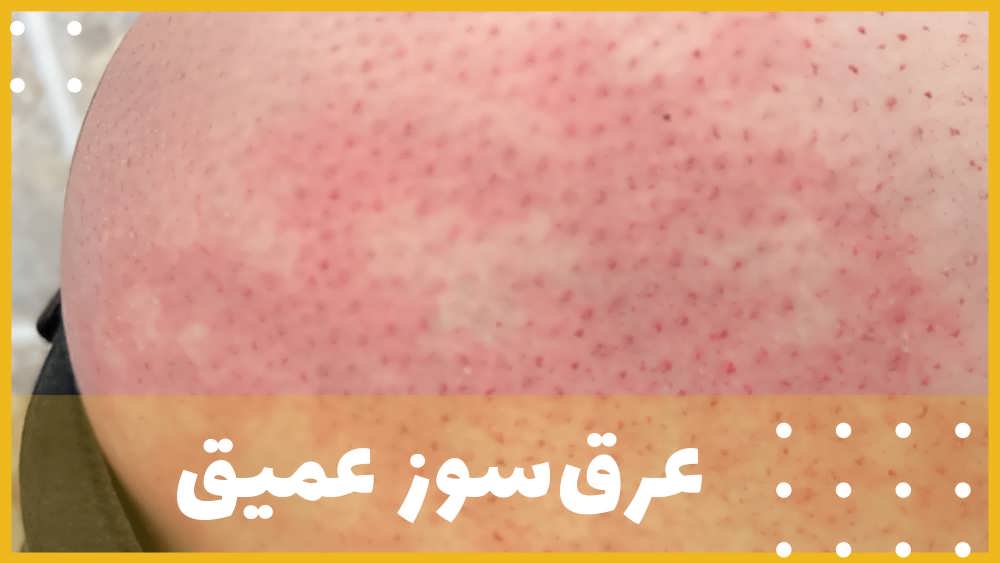 عرق سوز عمیق