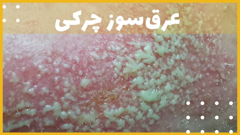 عرق سوز چرکی