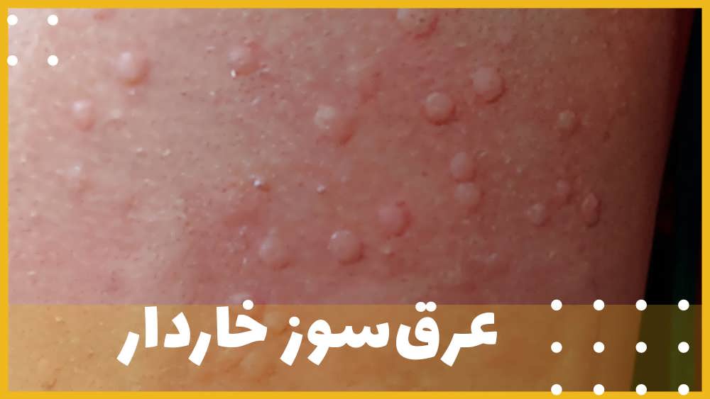 عرق سوز خاردار