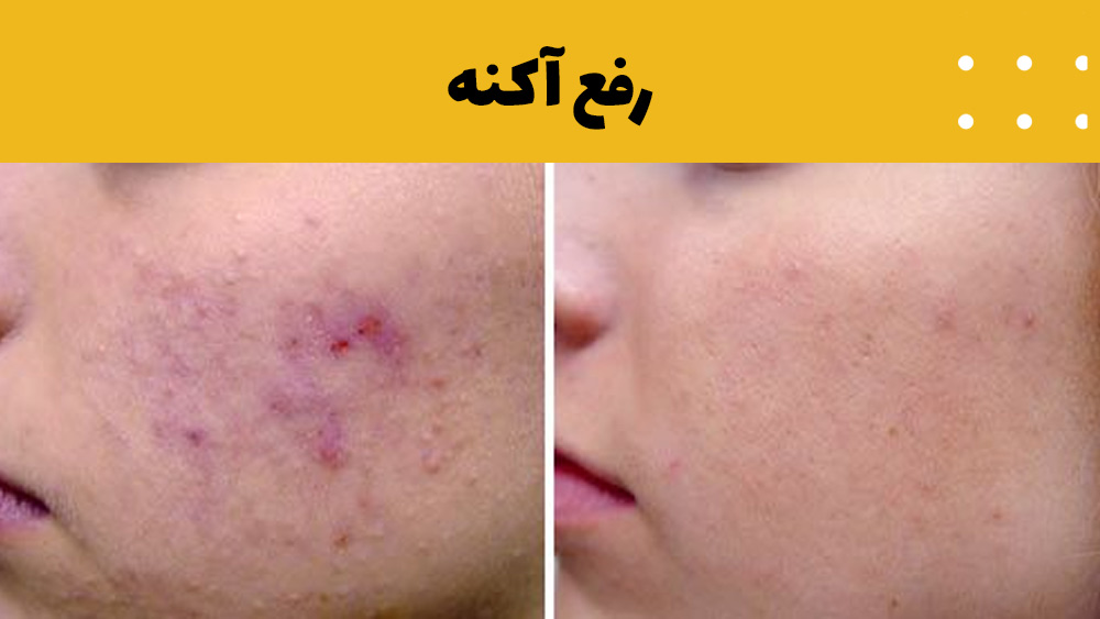 لیزر فوتونا برای درمان آکنه
