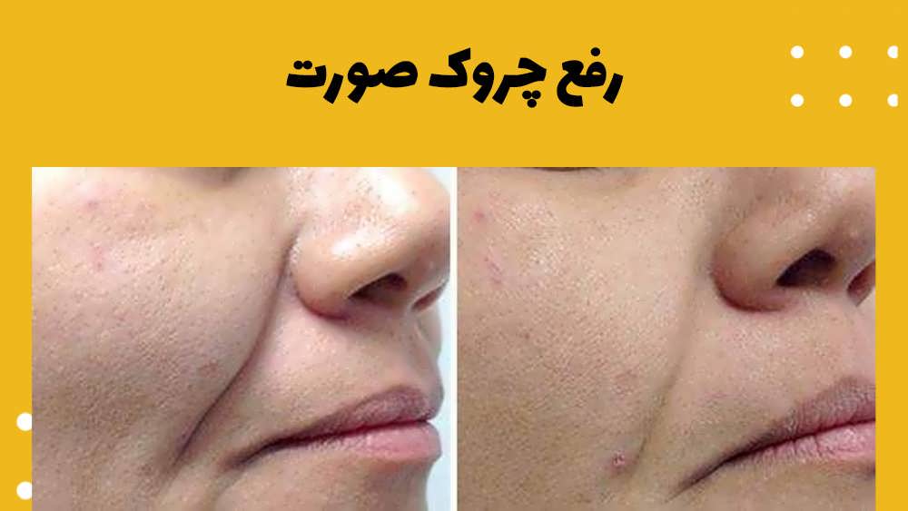 رفع چروک صورت