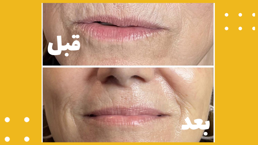 رفع چین و چروکهای صورت و گردن