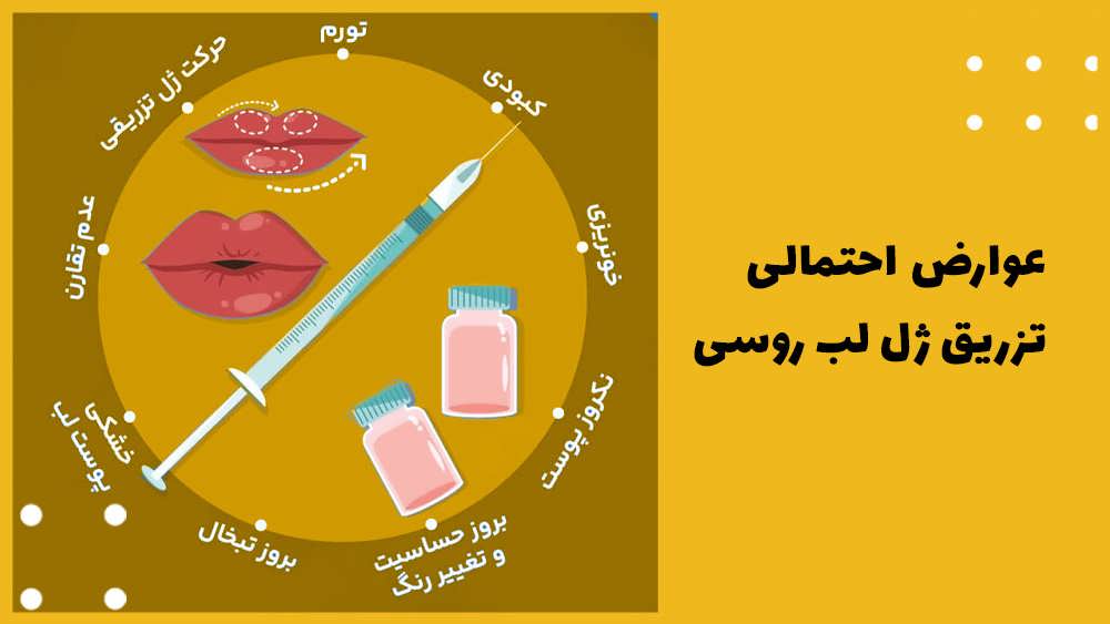 عوارض تزریق ژل لب روسی