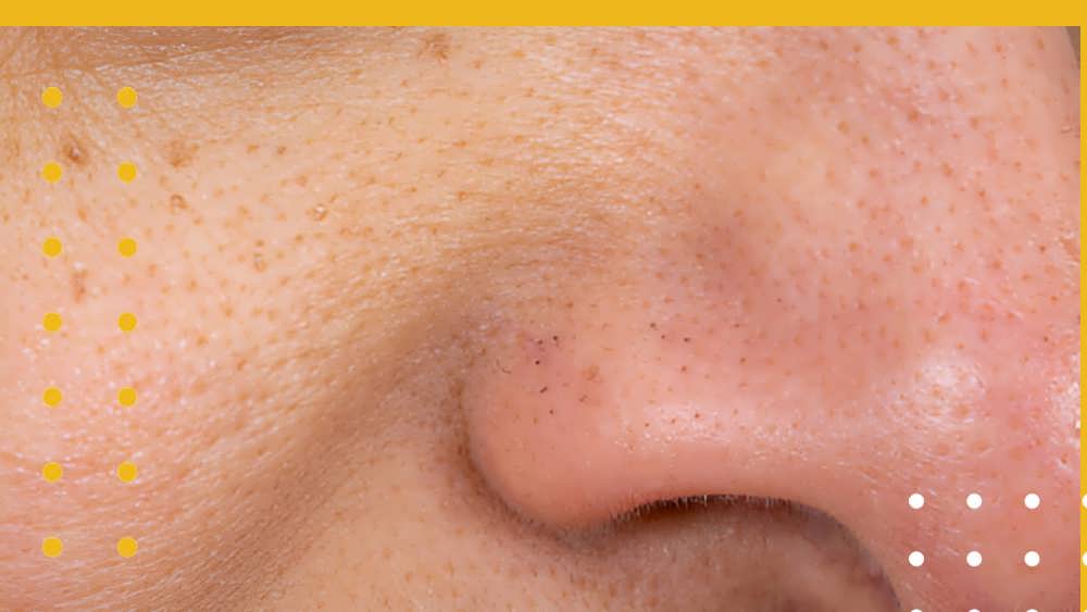 علت ایجاد منافذ باز پوست چیست؟