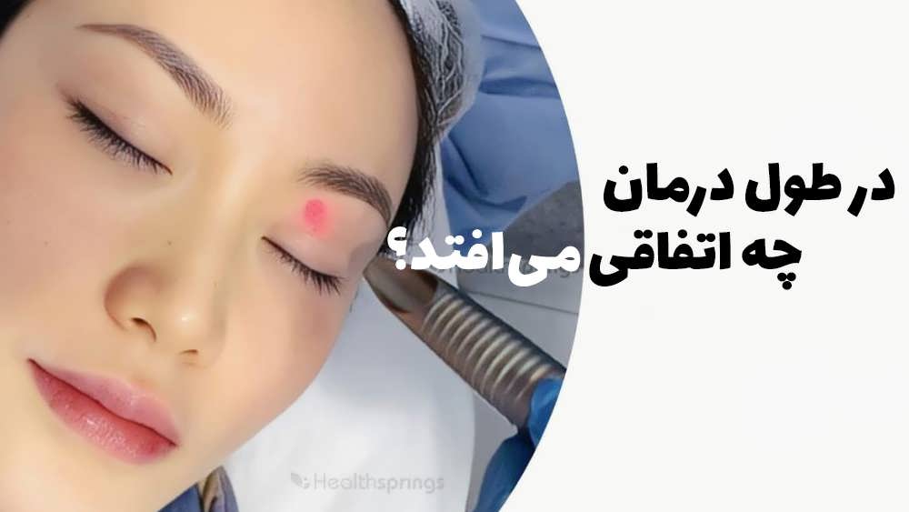 در طول درمان چه اتفاقی می افتد؟