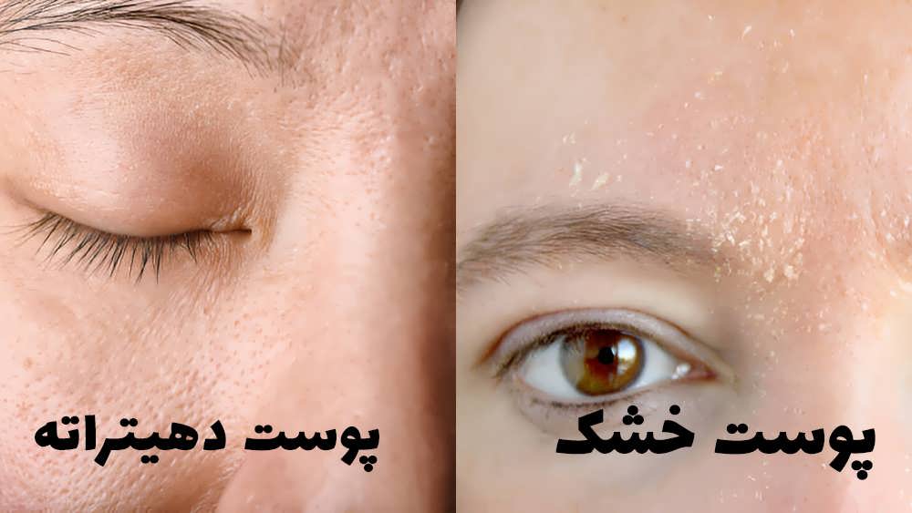تفاوت پوست خشک و پوست دهیدراته در چیست؟