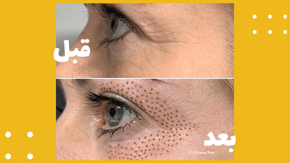 پلاسما جت برای کدام قسمتهای صورت قابل انجام است؟